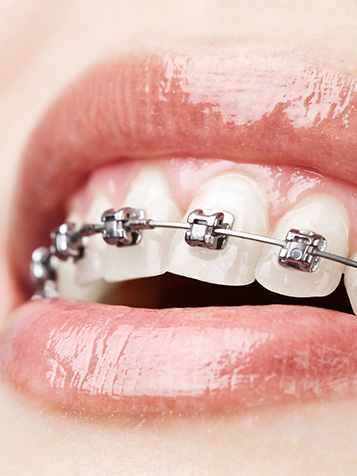 self ligating braces